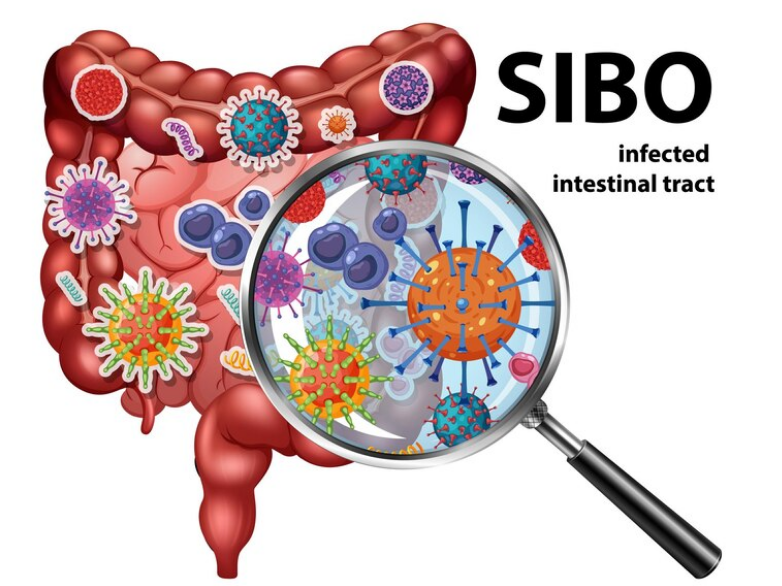 تشخيص فرط نمو البكتيريا في الأمعاء الدقيقة
